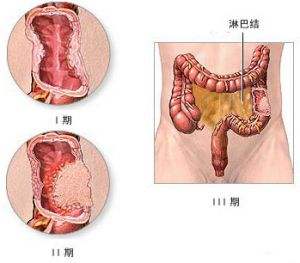 肠炎的症状.jpg