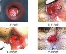 内痔症状图.jpg