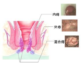 痔疮长包.jpg